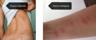 Чем комариные укусы отличаются от укусов постельных клопов?