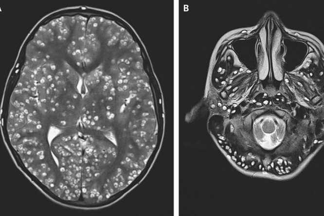 Может ли человек заражаться червями в мозгу?