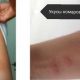 Можно ли не заметить укус клопа? Опасности и признаки клоповой атаки