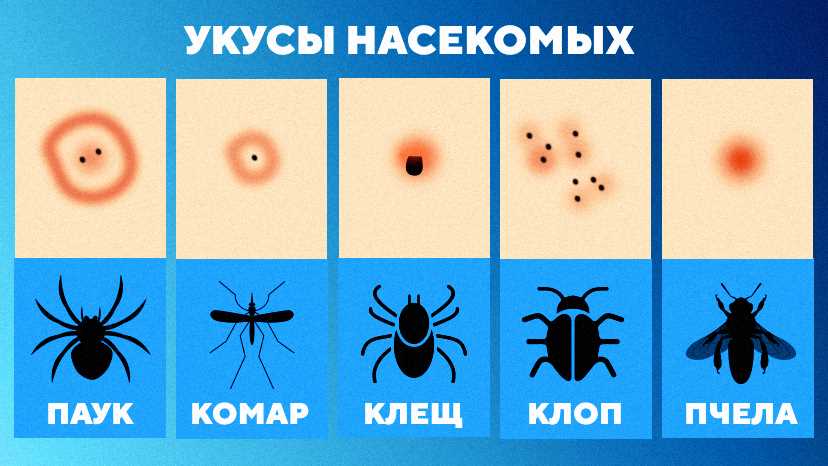 Как предотвратить аллергическую реакцию