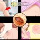 Чем комариные укусы отличаются от укусов постельных клопов?