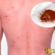Клопы: какую проблему могут вызвать эти насекомые в жизни человека?